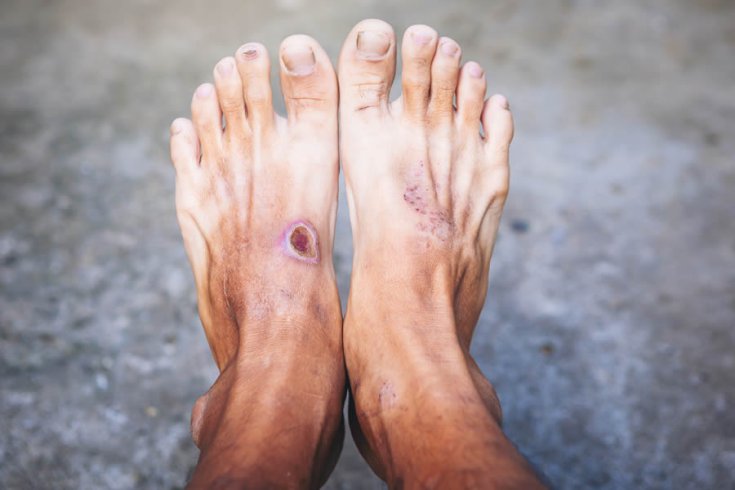 Early Signs for Diabetic Foot Sore